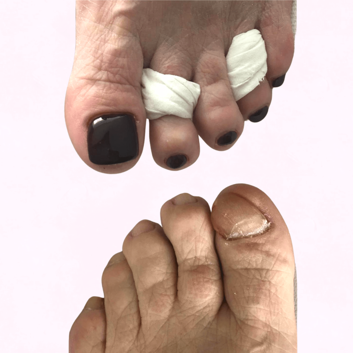 Toenail Reconstruction Kit - Pedisafe Starter Case (Lamp included)