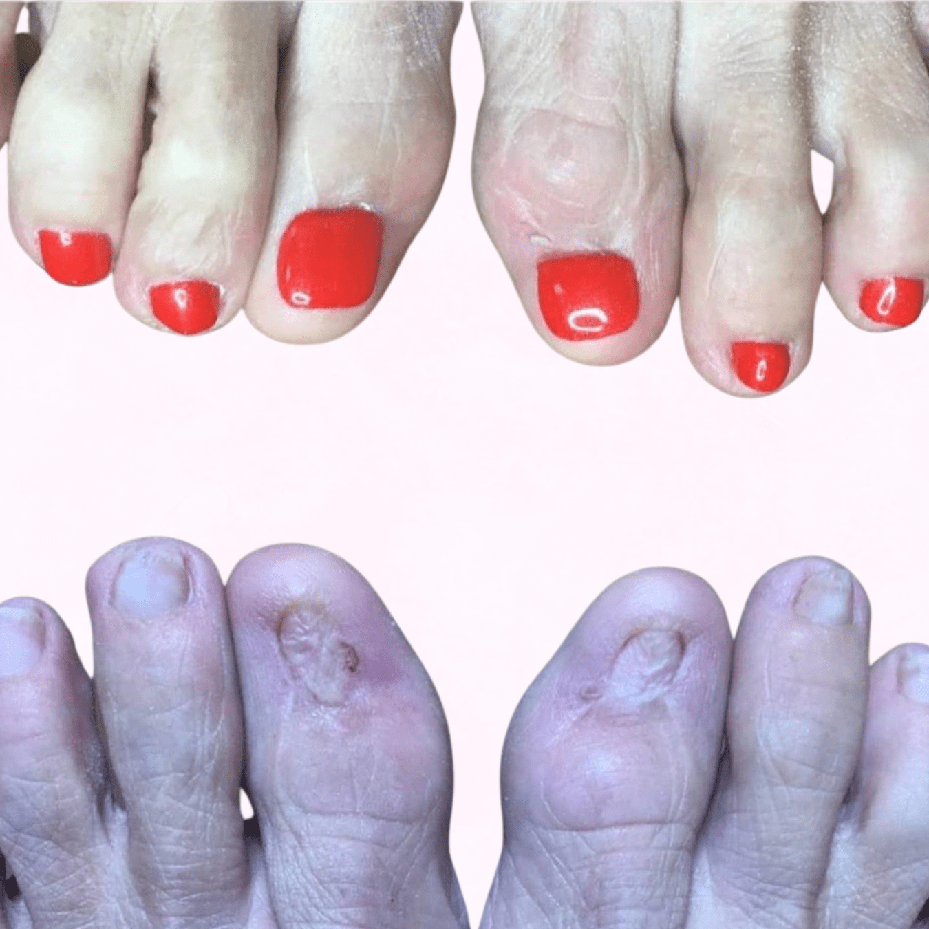 Toenail Reconstruction Kit Pedisafe Starter Case (Lamp included